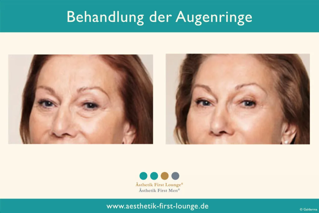 Vorher_nachher_marionettenfalten