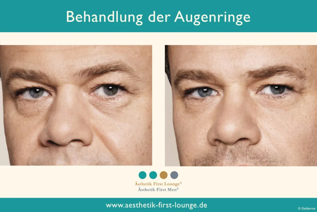 Vorher_nachher_marionettenfalten