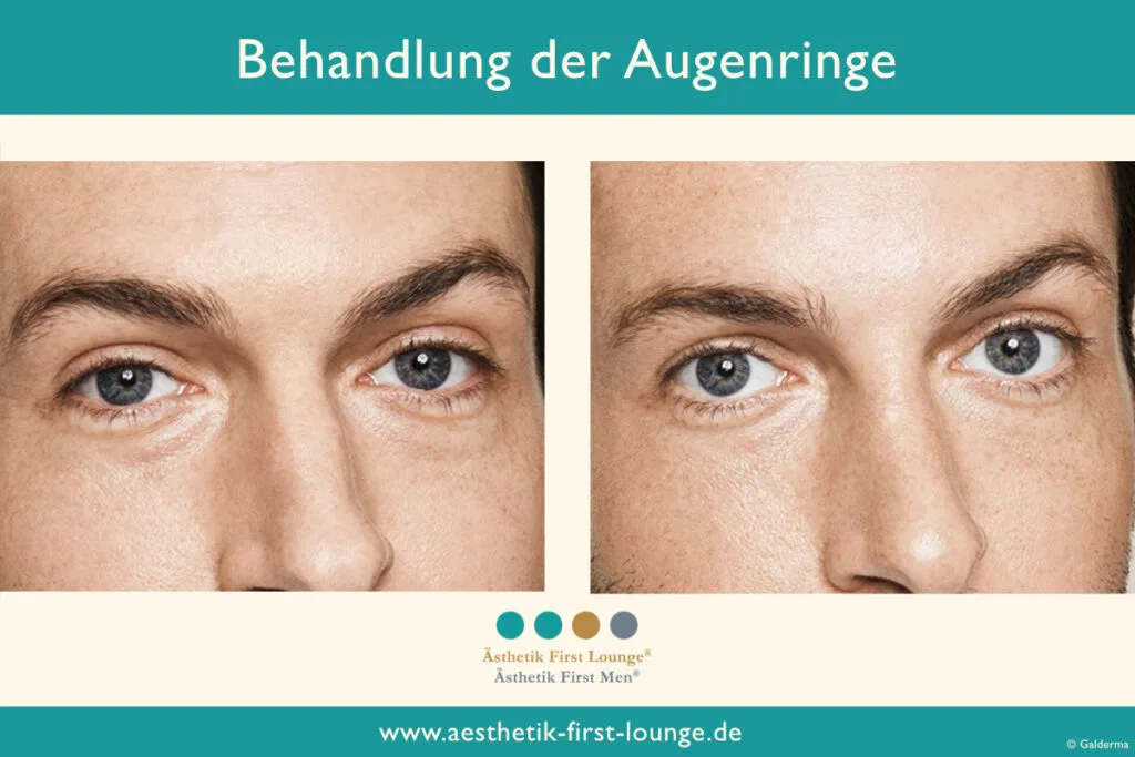 Vorher_nachher_marionettenfalten