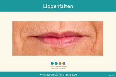 lippenfalten-entfernen_aesthetik-first-lounge