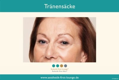 traenensaecke-entfernen-mit-hyaluron-aesthetik-first-lounge