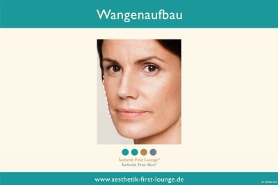 wangen-aufspritzen-wangenaufbau-mit-hyaluron