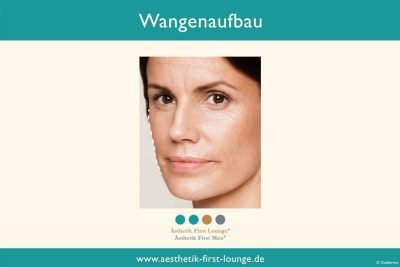 wangen-aufspritzen-wangenaufbau-mit-hyaluron