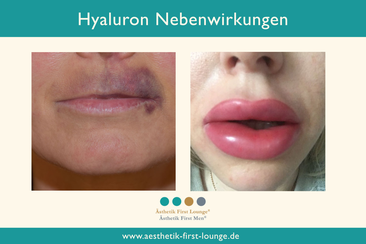 Volle Lippen: Die wichtigsten Infos zu Hyaluron-Injektionen