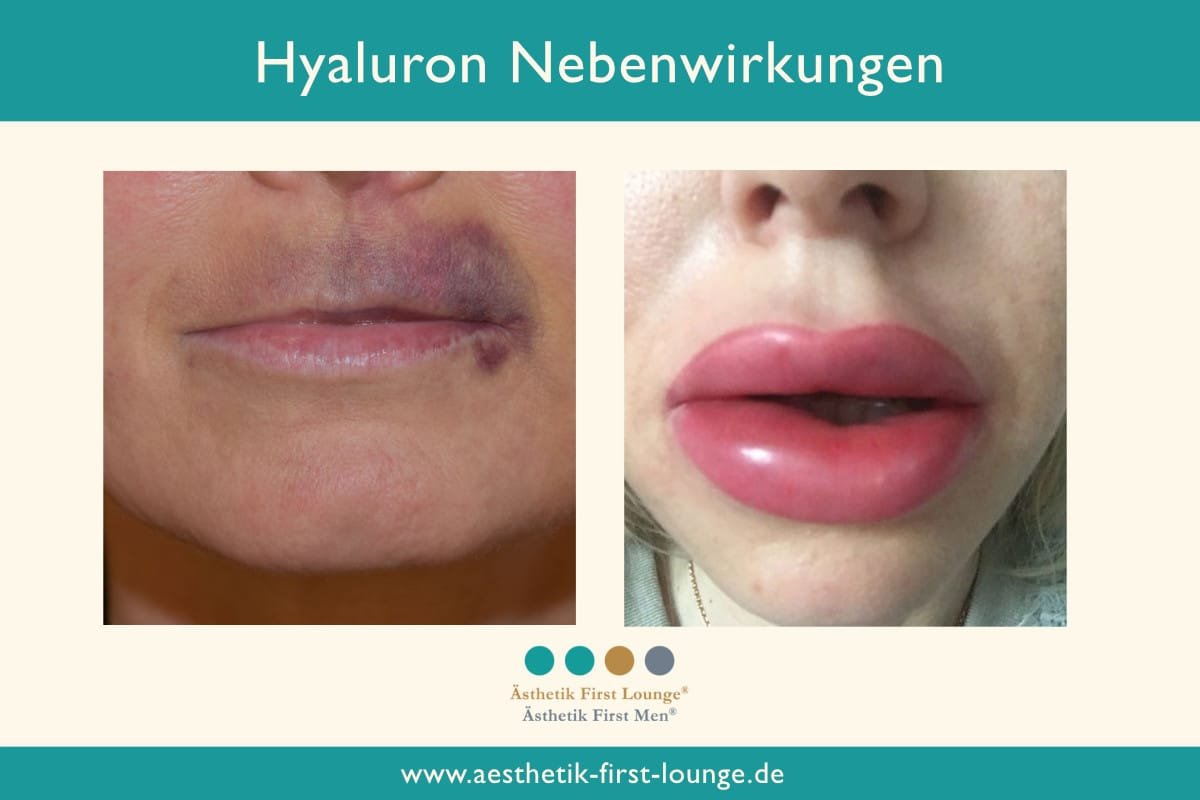 Wissenswertes zur Faltenbehandlung Ästhetik First Lounge