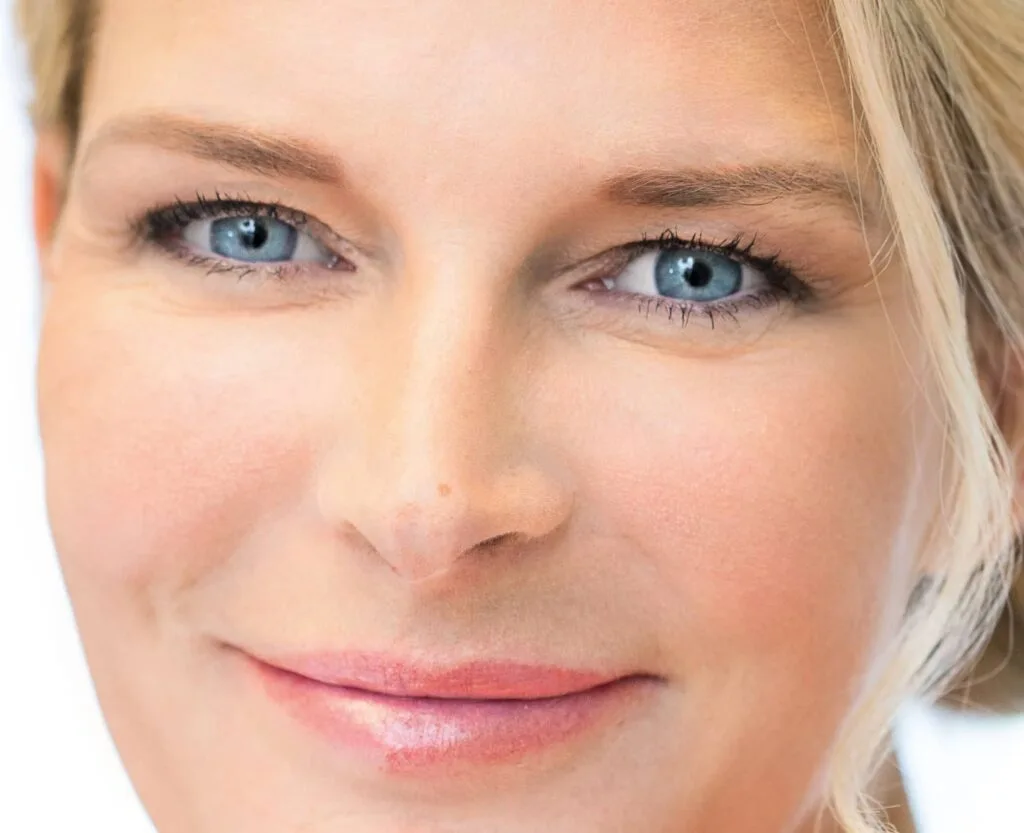 Frau mit Facelift ohne OP mit Hyaluronsäure