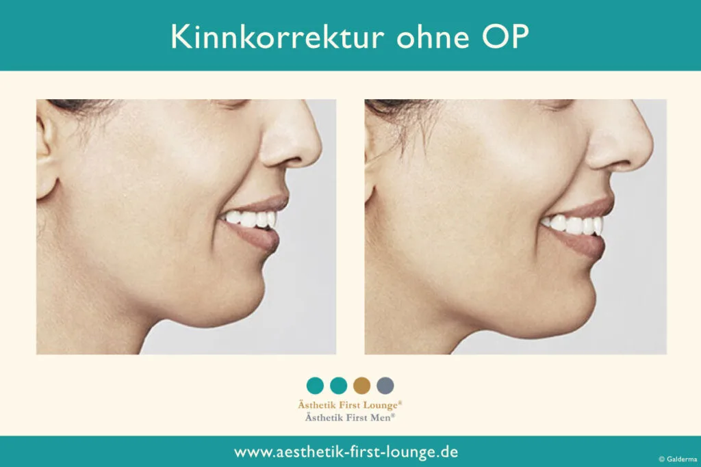 Kinnkorrektur ohne OP mit Hyaluron Beispiel 1 | Ästhetik First Lounge
