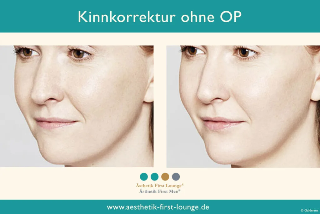 Kinnkorrektur ohne OP mit Hyaluron Beispiel 2 | Ästhetik First Lounge