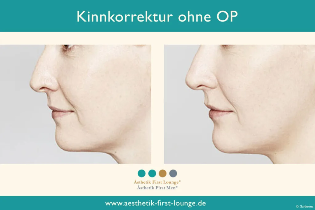 Kinnkorrektur ohne OP mit Hyaluron Beispiel 3 | Ästhetik First Lounge