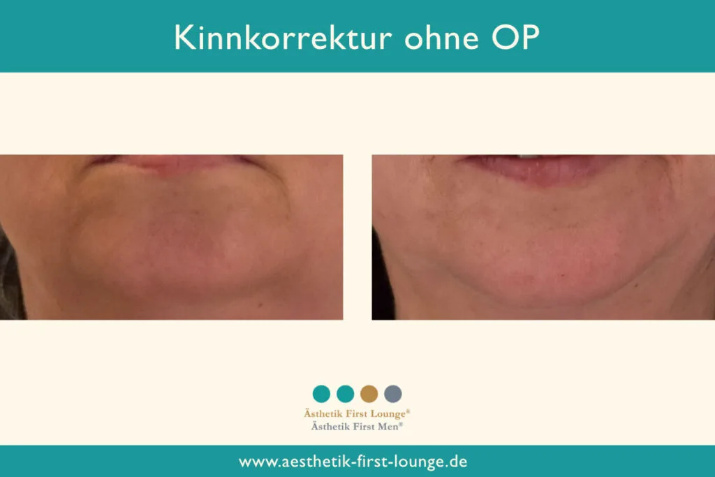 Kinnkorrektur ohne OP mit Hyaluron Beispiel 4 | Ästhetik First Lounge