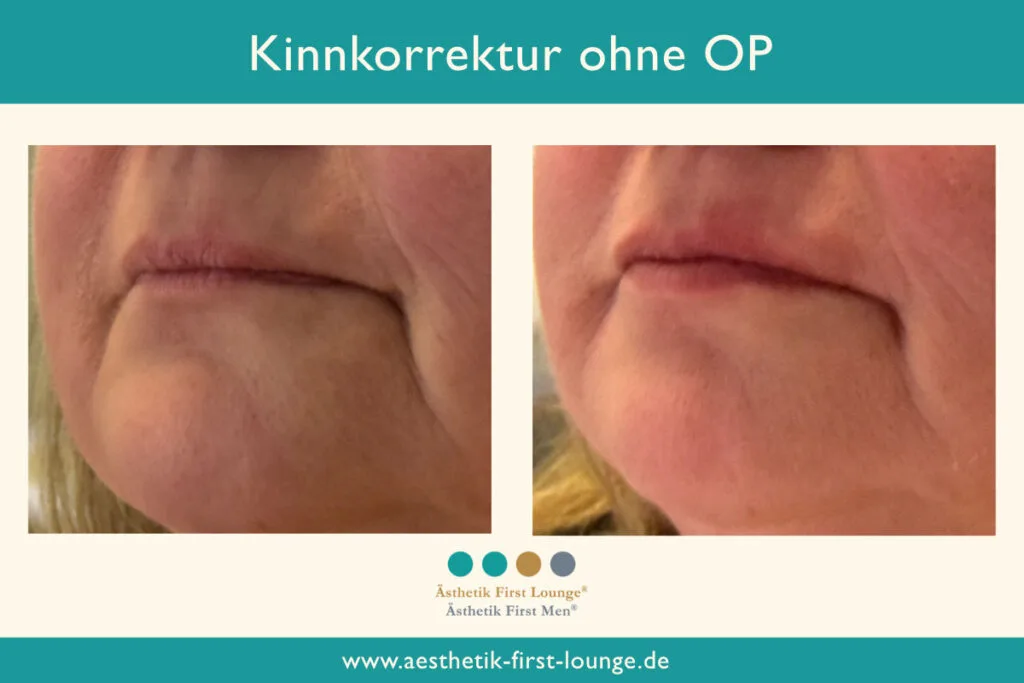 Kinnkorrektur ohne OP mit Hyaluron Beispiel 5 | Ästhetik First Lounge