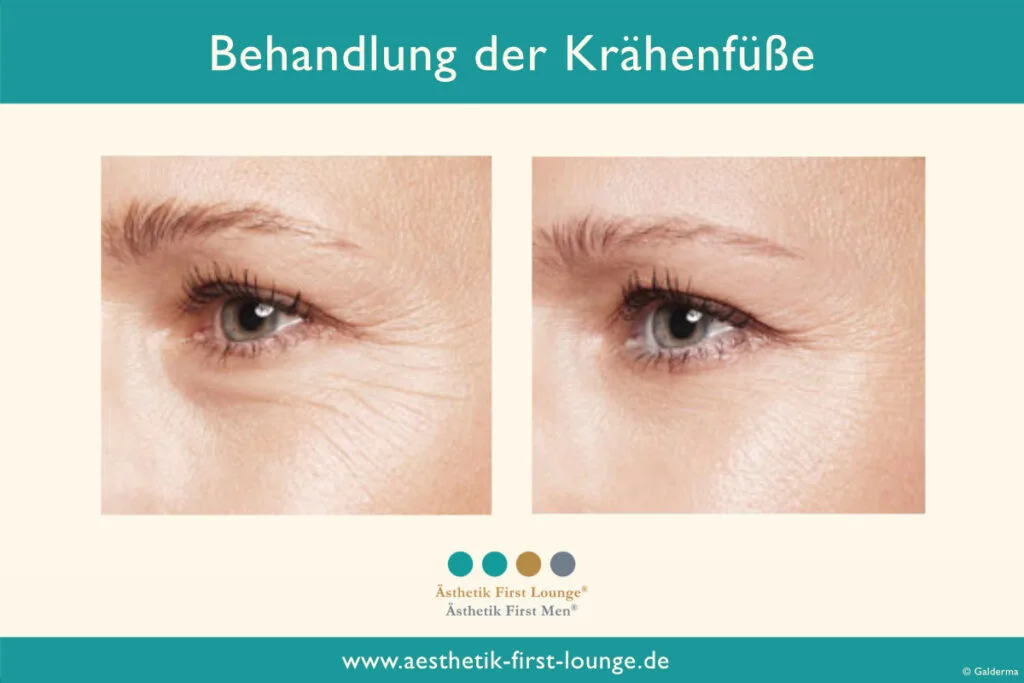 Vorher_nachher_marionettenfalten