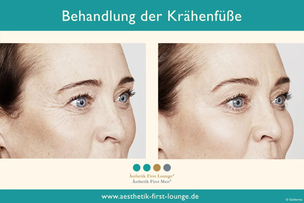 Vorher_nachher_marionettenfalten