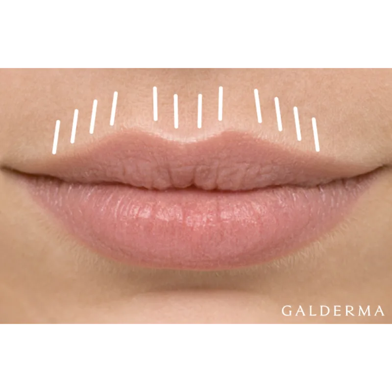 lip-flip-berlin-botox-hyaluron_aesthetik-first-lounge-berlin