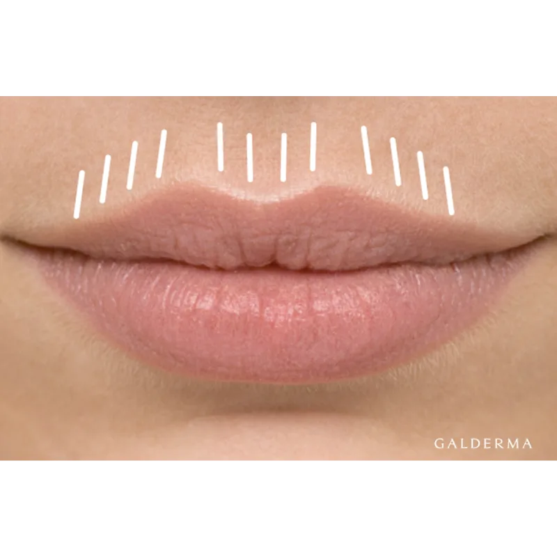 lip-flip-botox-aesthetik-first-lounge-berlin