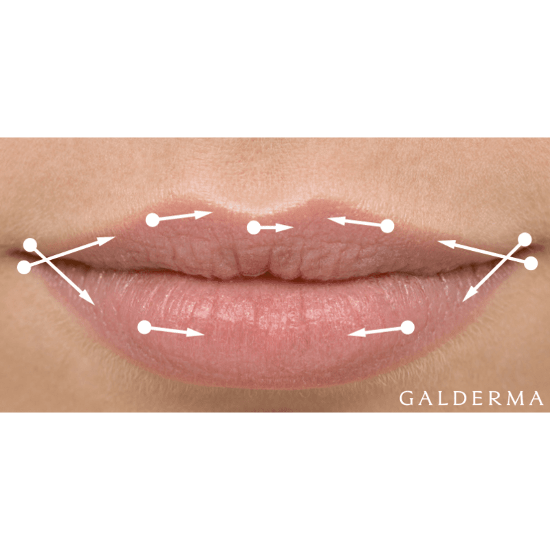 lippen-aufspritzen-berlin_hyaluron_aesthetik-first-lounge-berlin