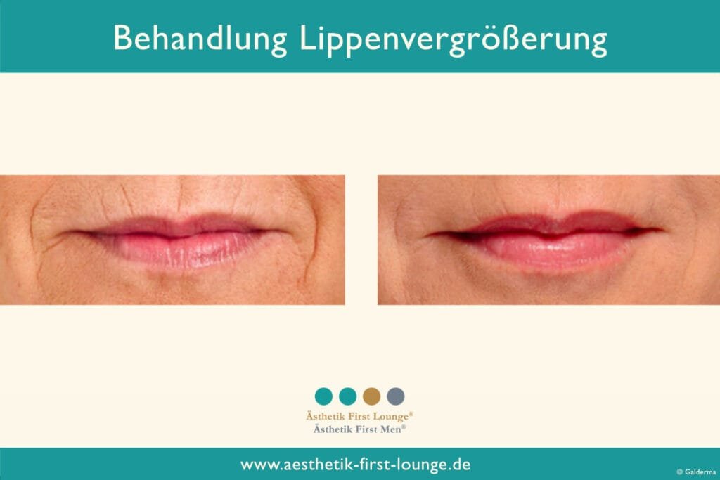 Lippenvolumen aufbauen Beispiel 1 | Ästhetik First Lounge