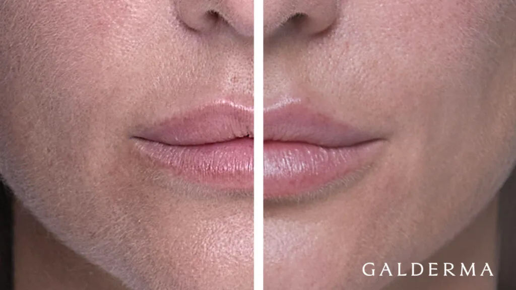 lippenbehandlungen-vorher-nacher-hyaluron-botox-berlin-16-9