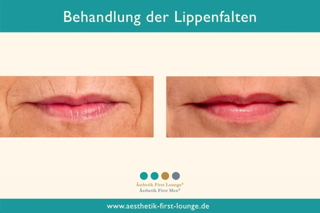 Lippenfalten entfernen mit Hyaluron Beispiel 1 | Ästhetik First Lounge