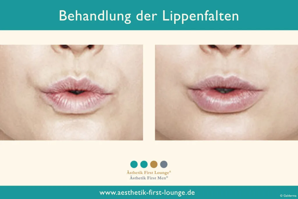 Lippenfalten entfernen mit Hyaluron Beispiel 2 | Ästhetik First Lounge