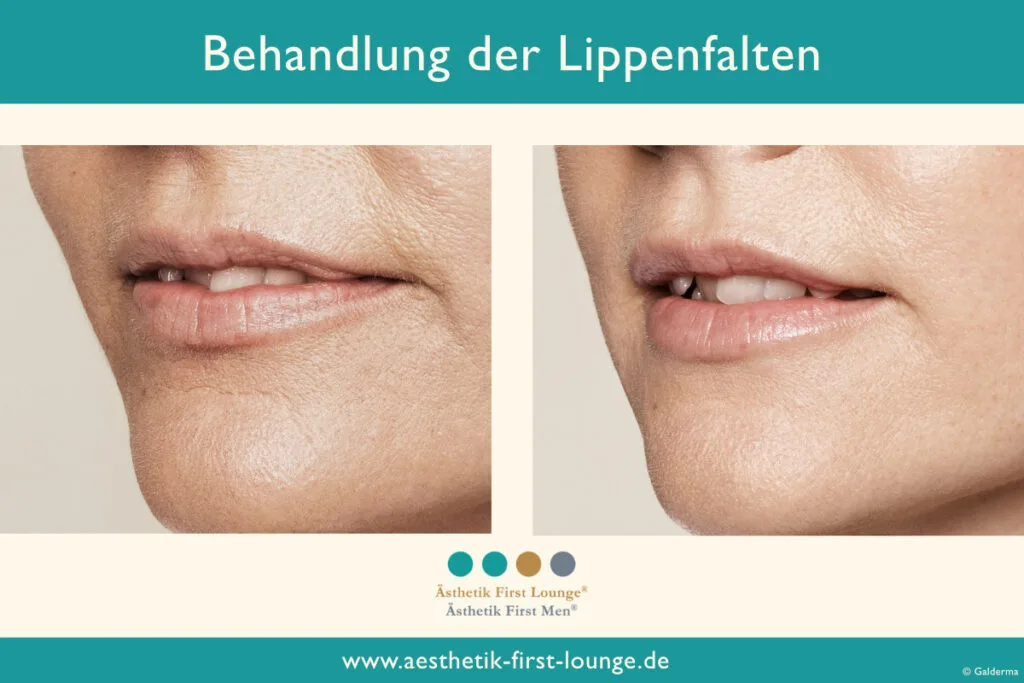 Lippenfalten entfernen mit Hyaluron Beispiel 3 | Ästhetik First Lounge