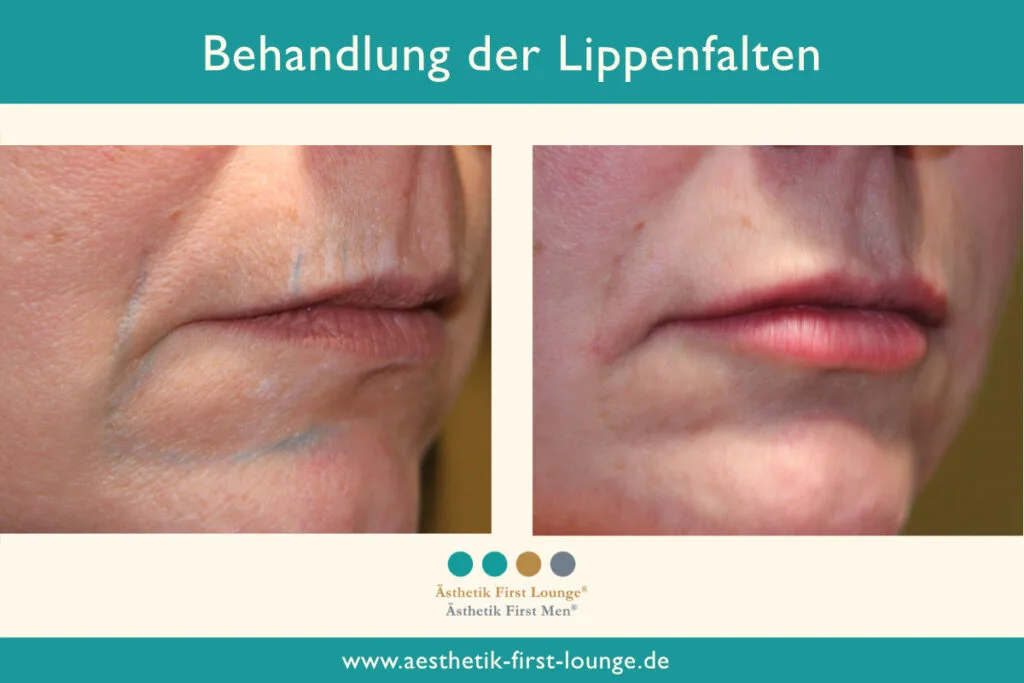 Lippenfalten entfernen mit Hyaluron Beispiel 4 | Ästhetik First Lounge
