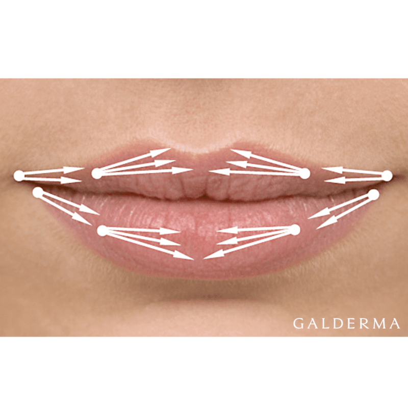 lippenkorrektur-berlin-hyaluron-aesthetik-first-lounge-berlin