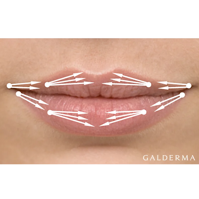 lippenkorrektur-berlin-hyaluron-aesthetik-first-lounge-berlin