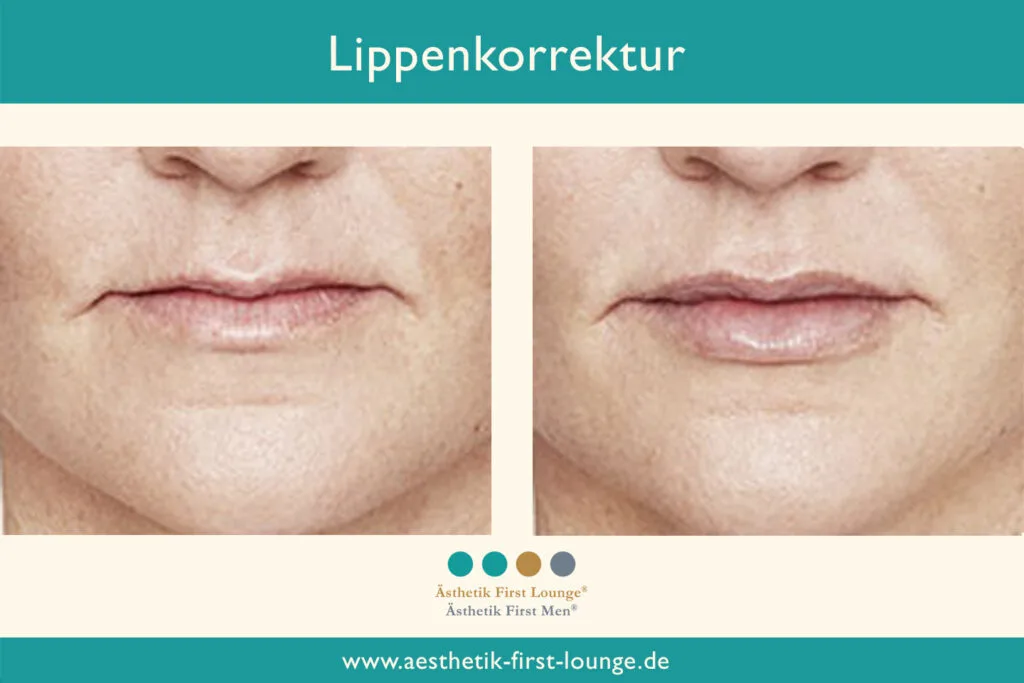 Lippenkorrektur mit Hyaluron Beispiel 1 | Ästhetik First Lounge