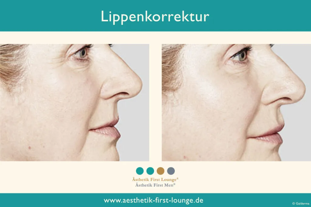 Lippenkorrektur mit Hyaluron Beispiel 2 | Ästhetik First Lounge