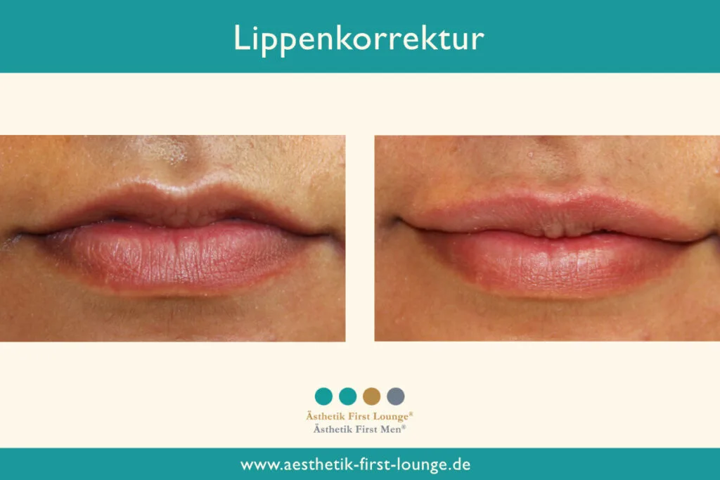 Lippenkorrektur mit Hyaluron Beispiel 3 | Ästhetik First Lounge