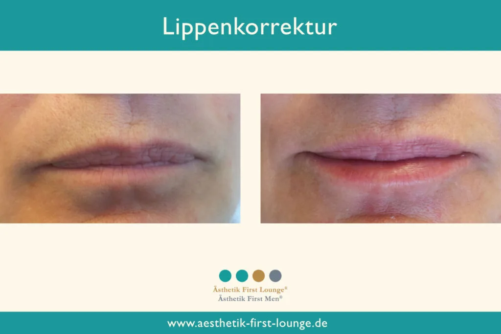 Lippenkorrektur mit Hyaluron Beispiel 4 | Ästhetik First Lounge