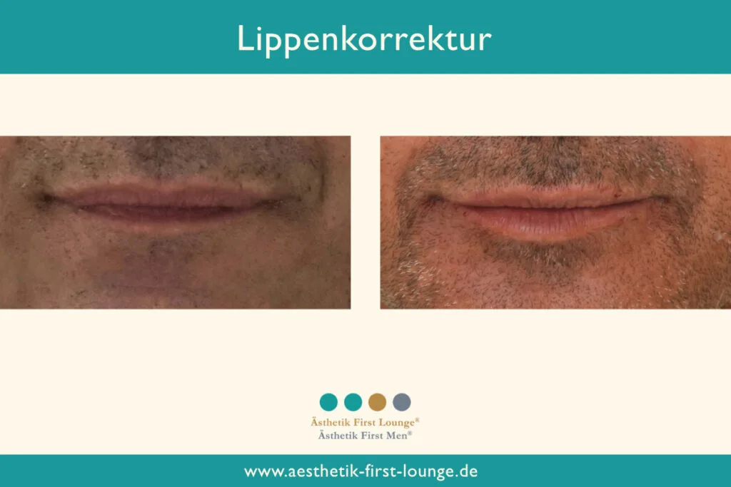 Lippenkorrektur mit Hyaluron Beispiel 4 | Ästhetik First Lounge