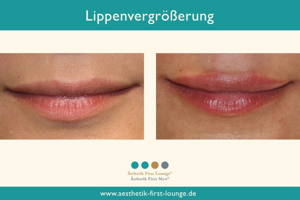 Lippenvolumen aufbauen Beispiel 10 | Ästhetik First Lounge