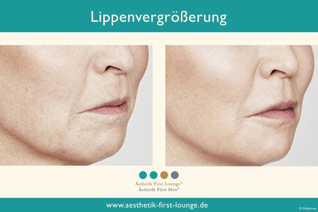 Lippenvolumen aufbauen Beispiel 6 | Ästhetik First Lounge