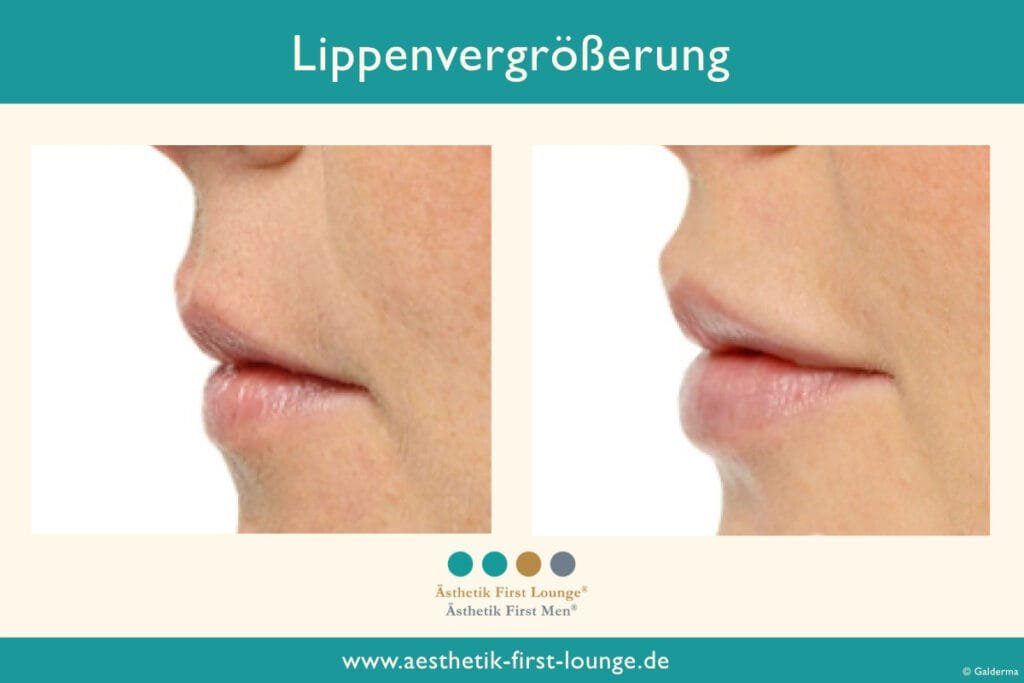 Lippenvolumen aufbauen Beispiel 7 | Ästhetik First Lounge