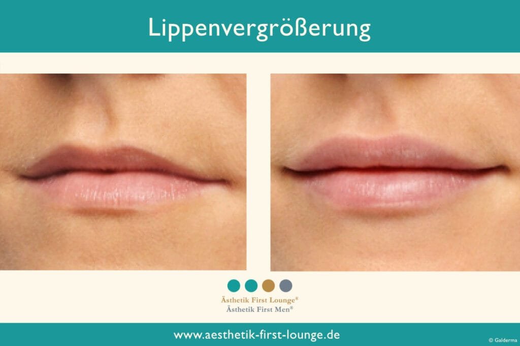 Lippenvolumen aufbauen Beispiel 8 | Ästhetik First Lounge