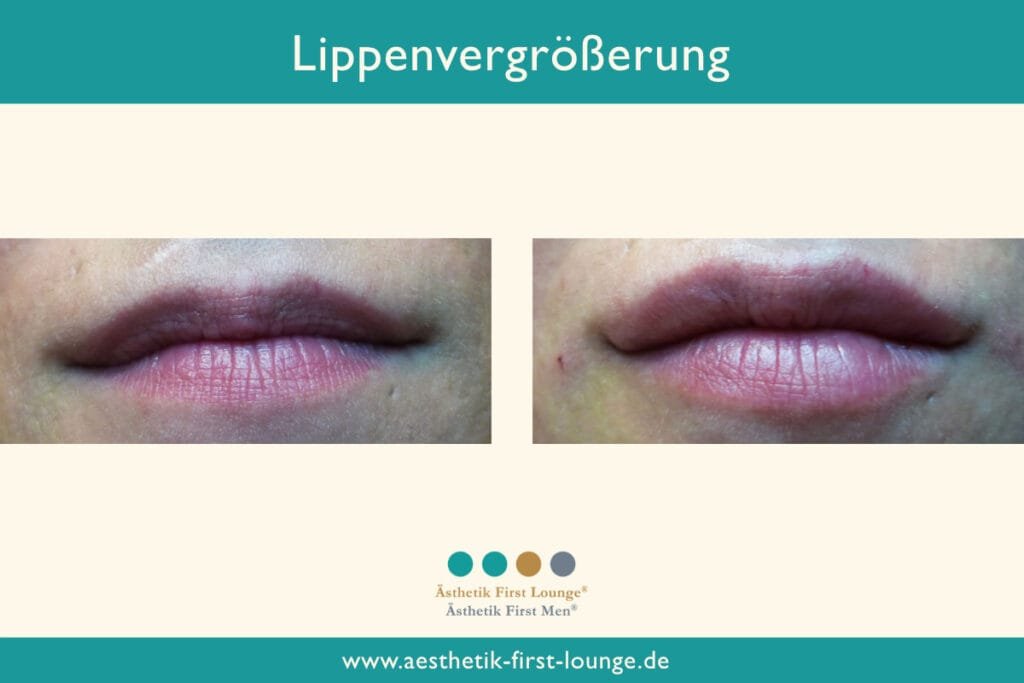 Lippenvolumen aufbauen Beispiel 9 | Ästhetik First Lounge