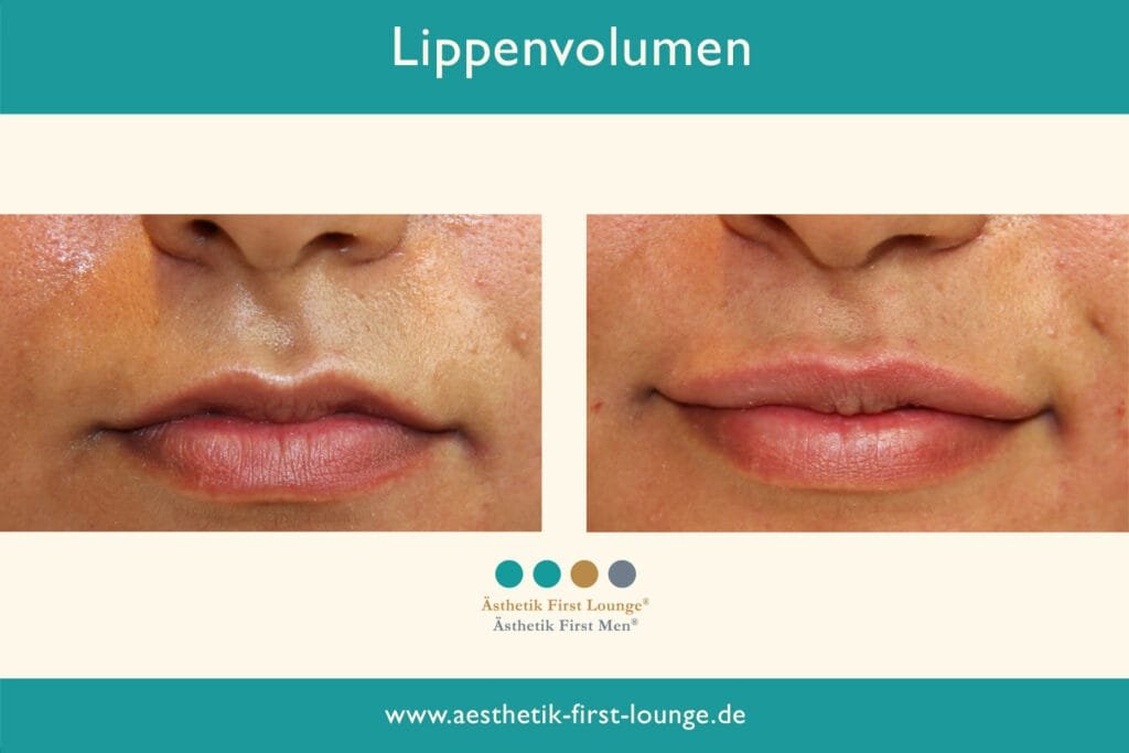 Lippenvolumen aufbauen Beispiel 2 | Ästhetik First Lounge