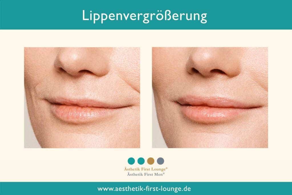 Lippenvolumen aufbauen Beispiel 5 | Ästhetik First Lounge