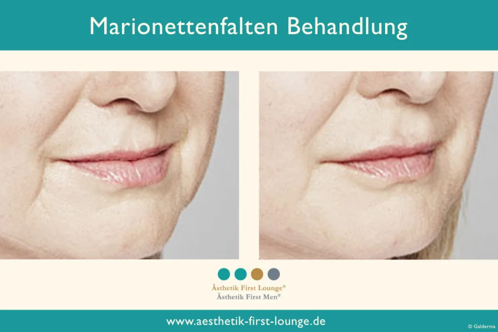 Marionettenfalte unterspritzen mit Hyaluron Beispiel 1 | Ästhetik First Lounge