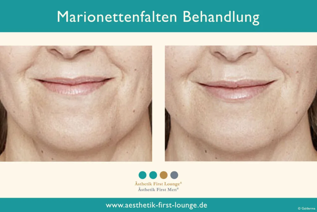 Marionettenfalte unterspritzen mit Hyaluron Beispiel 2 | Ästhetik First Lounge