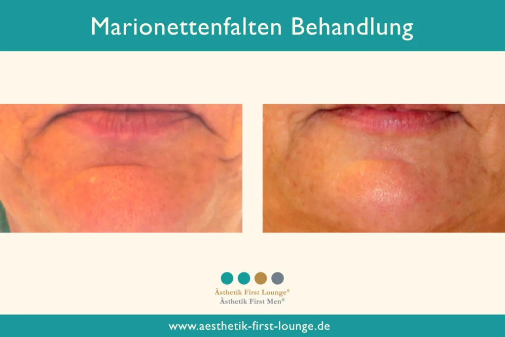 Marionettenfalte unterspritzen mit Hyaluron Beispiel 3 | Ästhetik First Lounge