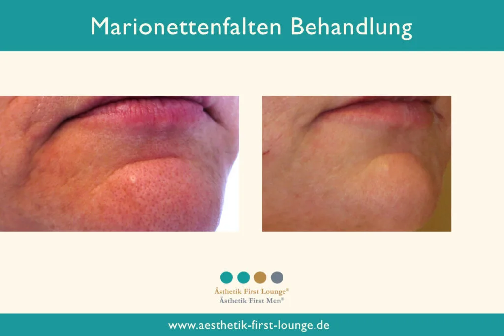 Marionettenfalte unterspritzen mit Hyaluron Beispiel 4 | Ästhetik First Lounge