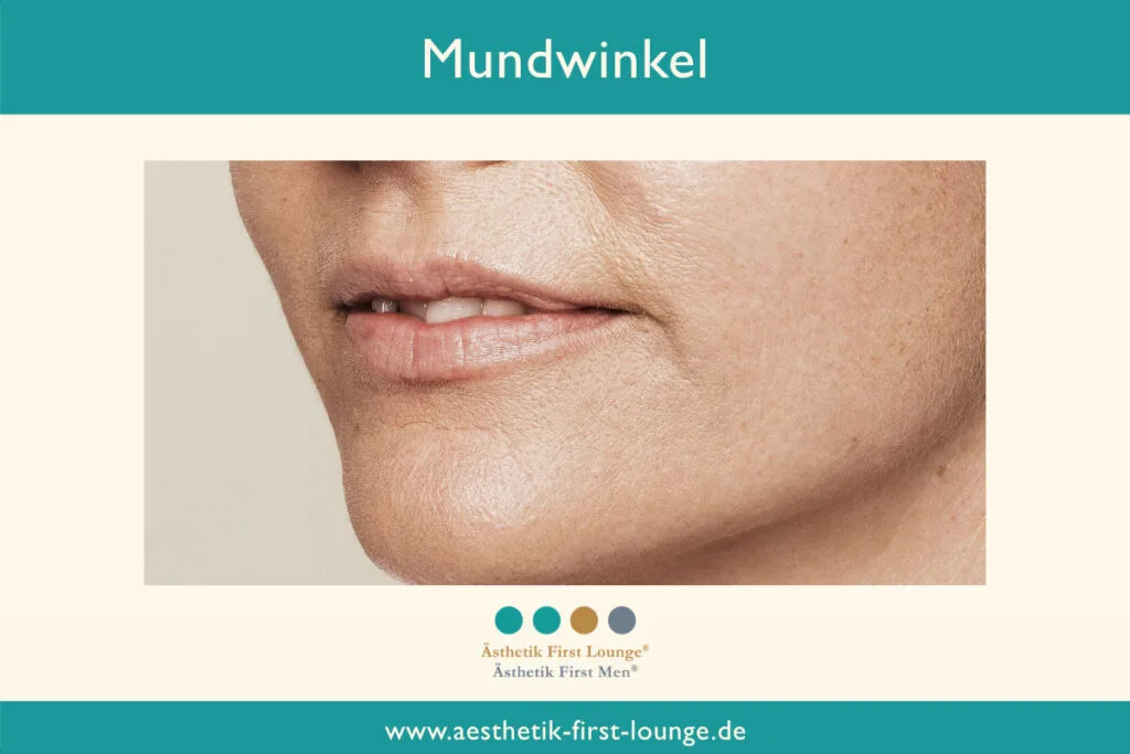 Mundwinkel anheben mit Hyaluron