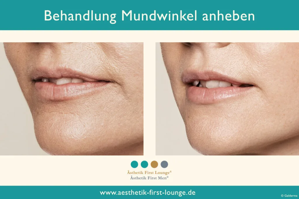 Mundwinkel anheben mit Hyaluron Beispiel 3 | Ästhetik First Lounge
