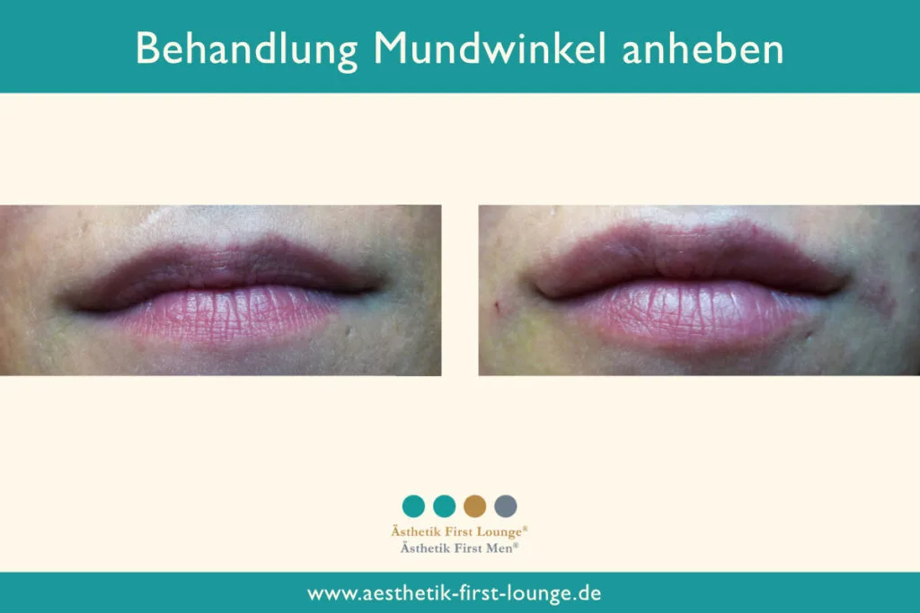 Mundwinkel anheben mit Hyaluron Beispiel 1 | Ästhetik First Lounge