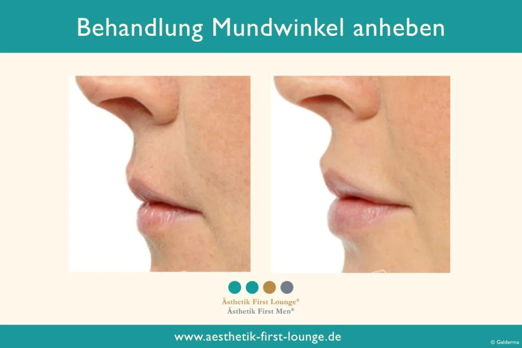 Mundwinkel anheben mit Hyaluron Beispiel 2 | Ästhetik First Lounge