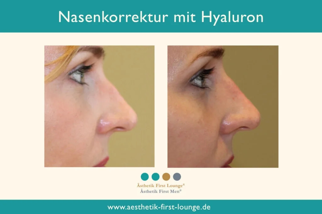 Nasenkorrektur ohne OP mit Hyaluron Beispiel 2 | Ästhetik First Lounge