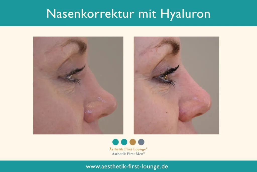 Nasenkorrektur ohne OP mit Hyaluron Beispiel 3 | Ästhetik First Lounge